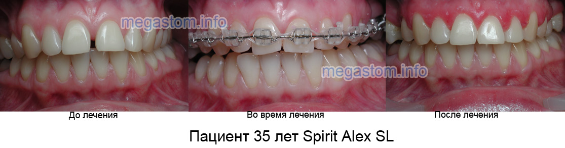 Пациент 35 лет Spirit Alex SL